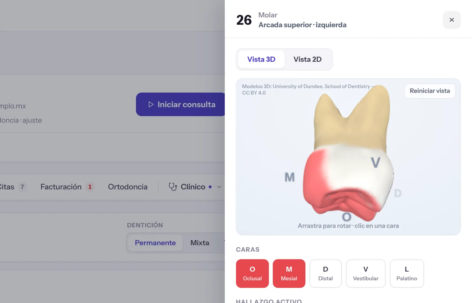 Odontograma 3D en software dental: molar con hallazgo marcado en caras oclusal y mesial